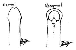 Normal penis and hypospadias