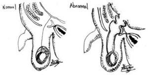 Patent opening and tract in an inguinal hernia